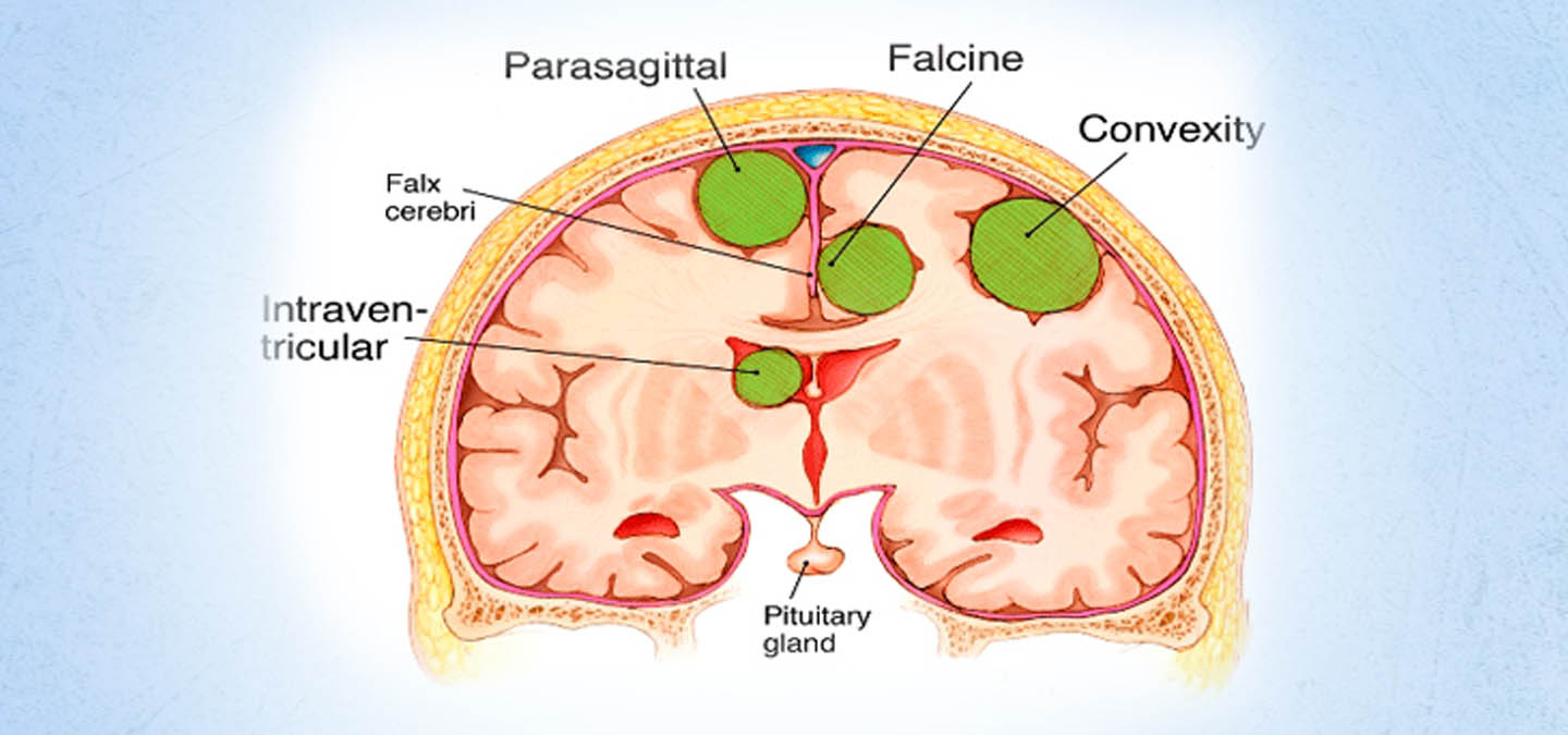 Intraventicular Surgery