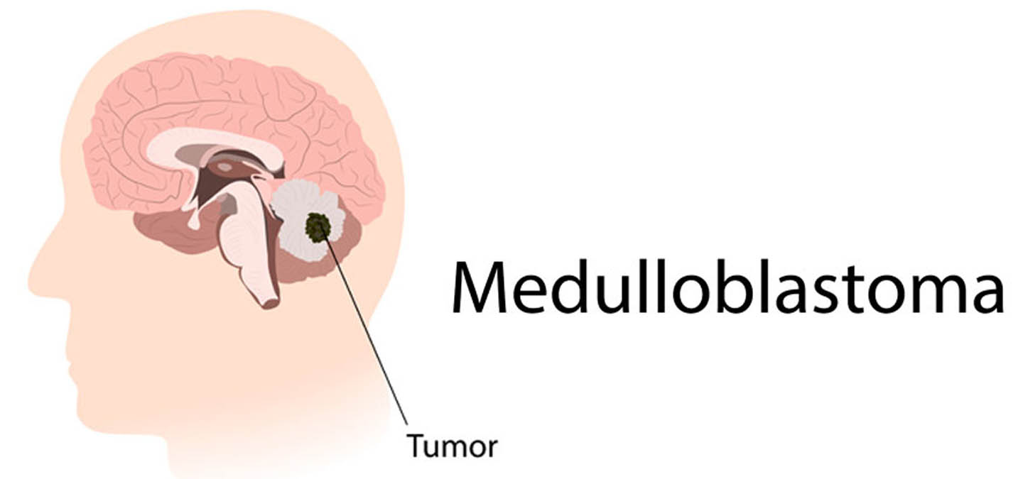 Glioma Surgery