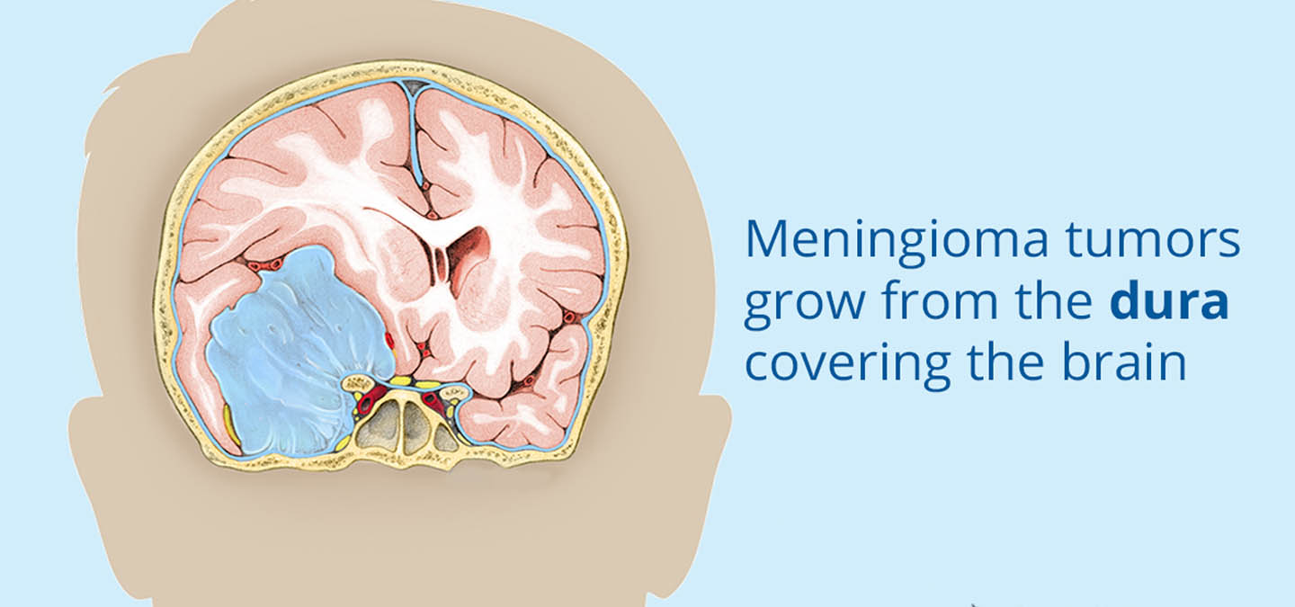 Meningioma