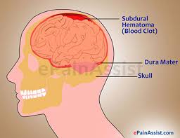 Glioma Surgery