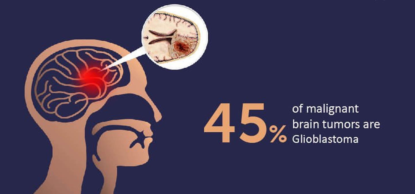 Glioma Surgery