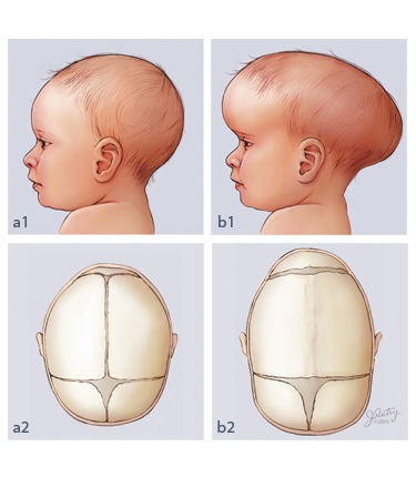 Glioma Surgery