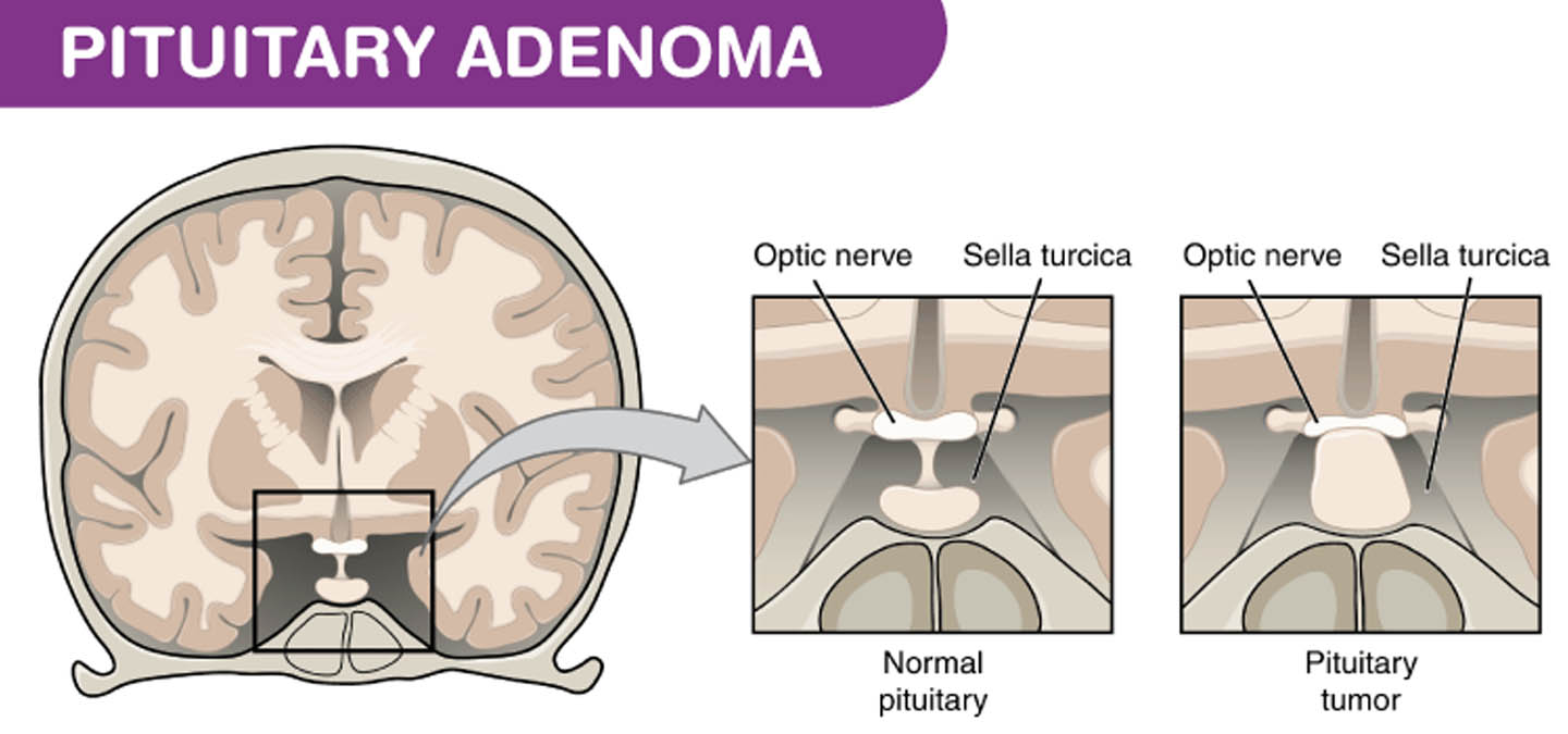 Pituitary Adenoma