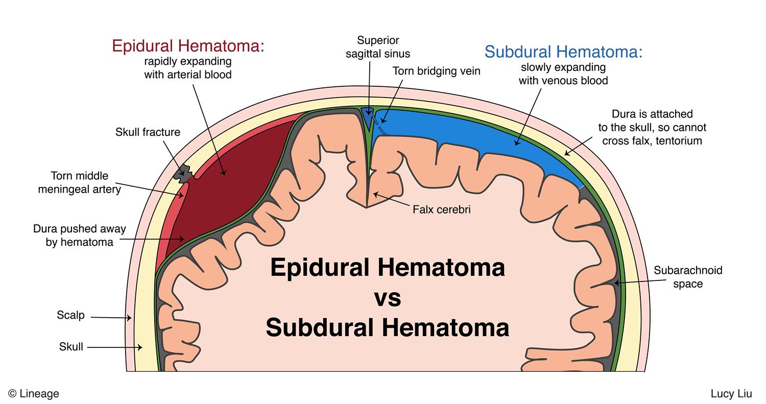 Glioma Surgery