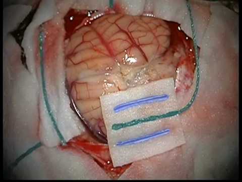 Medulloblastoma